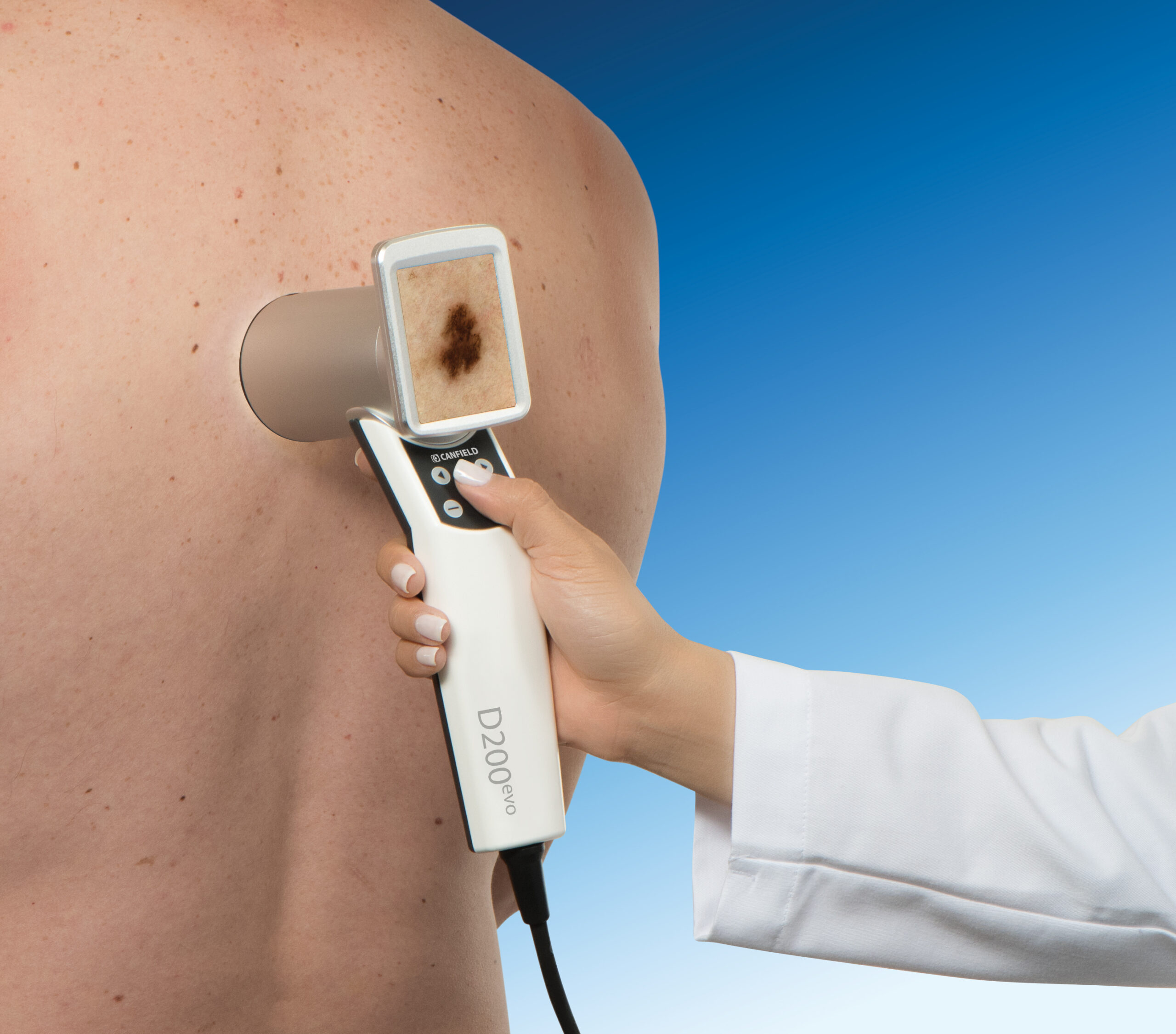 detection cancer peau